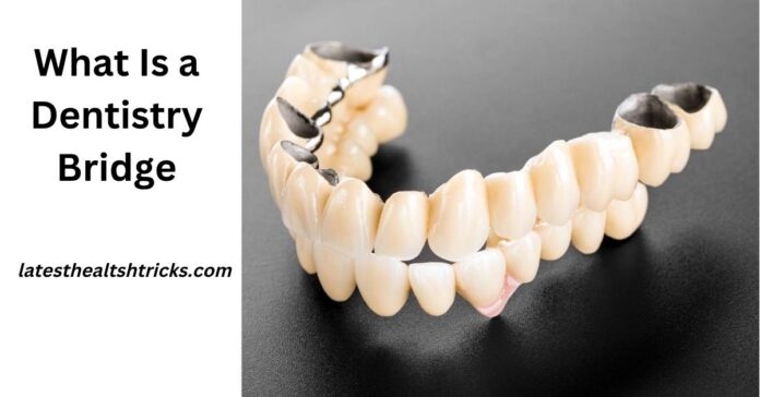 What Is a Dentistry Bridge