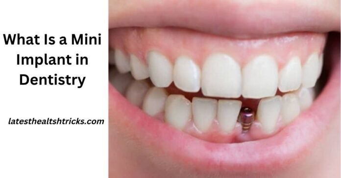 What Is a Mini Implant in Dentistry