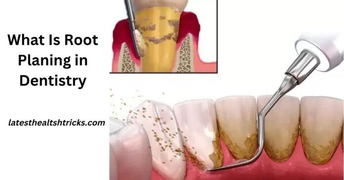 What Is Root Planing in Dentistry