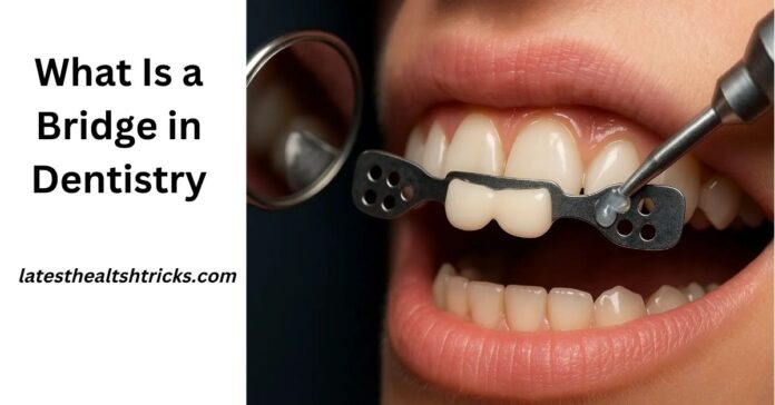 What Is a Bridge in Dentistry