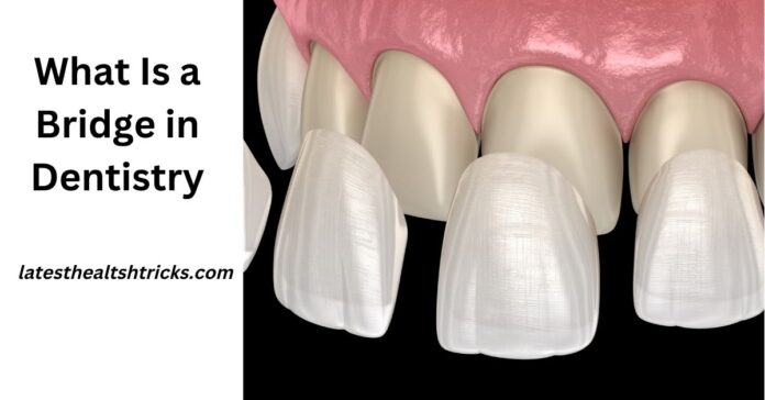 What Is a Veneer in Dentistry