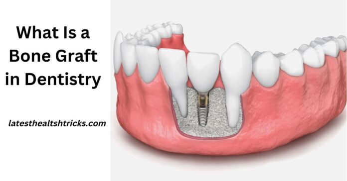 What Is a Bone Graft in Dentistry