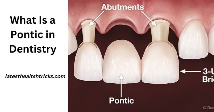 What Is a Pontic in Dentistry