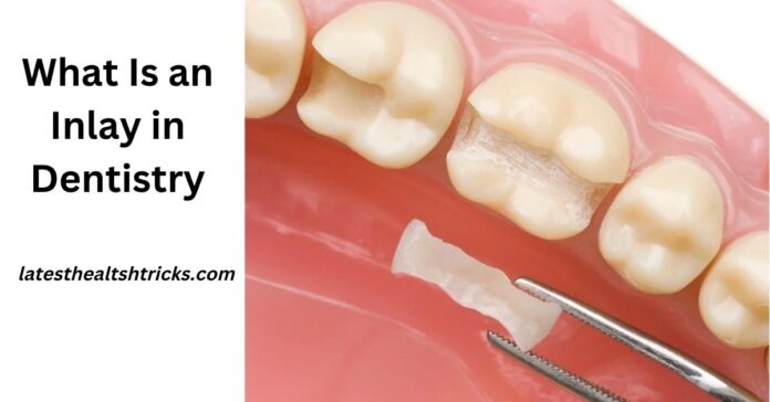 What Is an Inlay in Dentistry