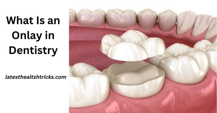 What Is an Onlay in Dentistry