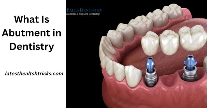 What Is Abutment in Dentistry