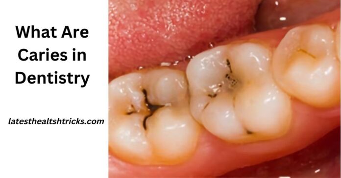 What Are Caries in Dentistry